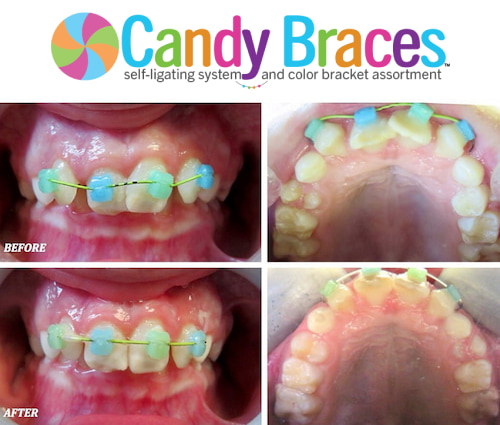 Candy Braces | Happy Smiles with Colored Braces